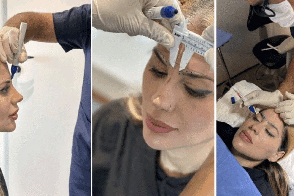Paciente em preparação para transplante capilar, com marcações na linha do cabelo feitas pelo médico antes do procedimento.