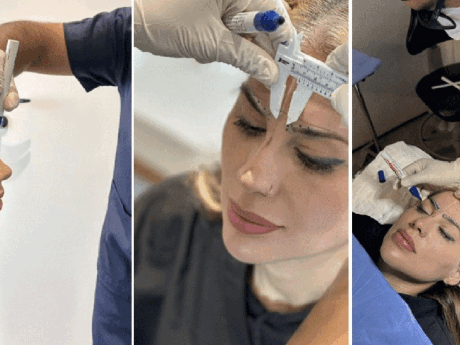 Paciente em preparação para transplante capilar, com marcações na linha do cabelo feitas pelo médico antes do procedimento.