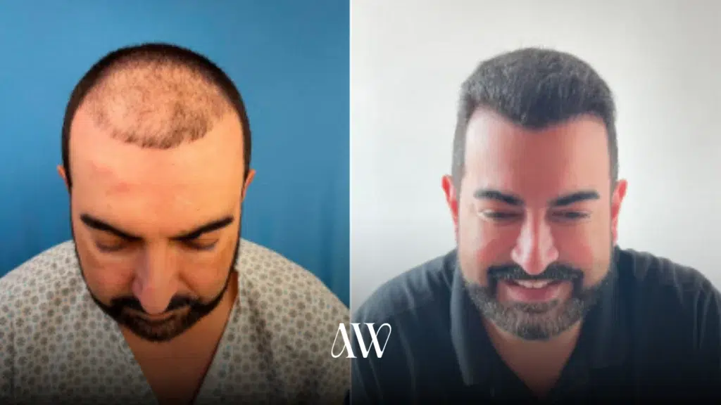 transplante capilar natural wells