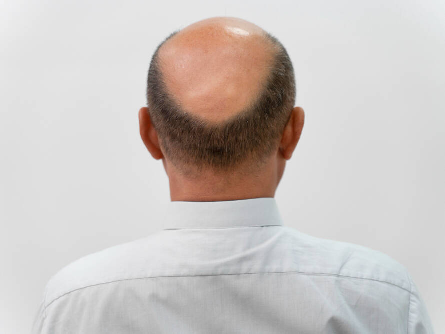homem entendendo por que a calvície não atinge a nuca