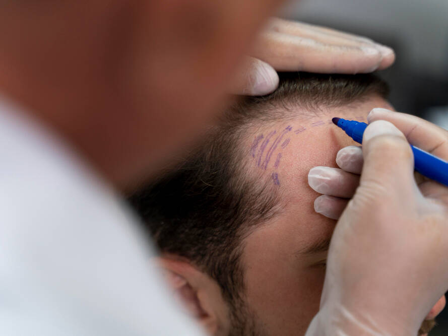 cirurgião especialista em transplante capilar