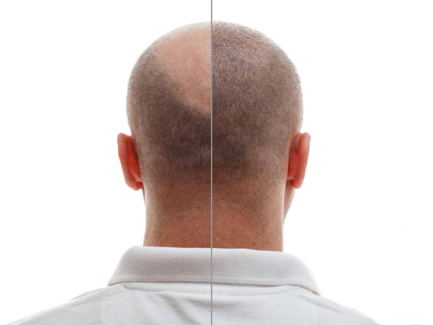 protagonismo brasileiro na cirurgia de transplante capilar