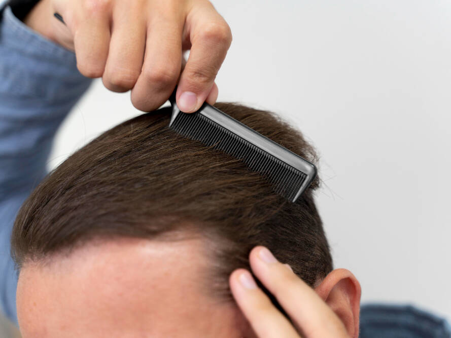 Transplante capilar feito por equipe técnica ou pelo cirurgião