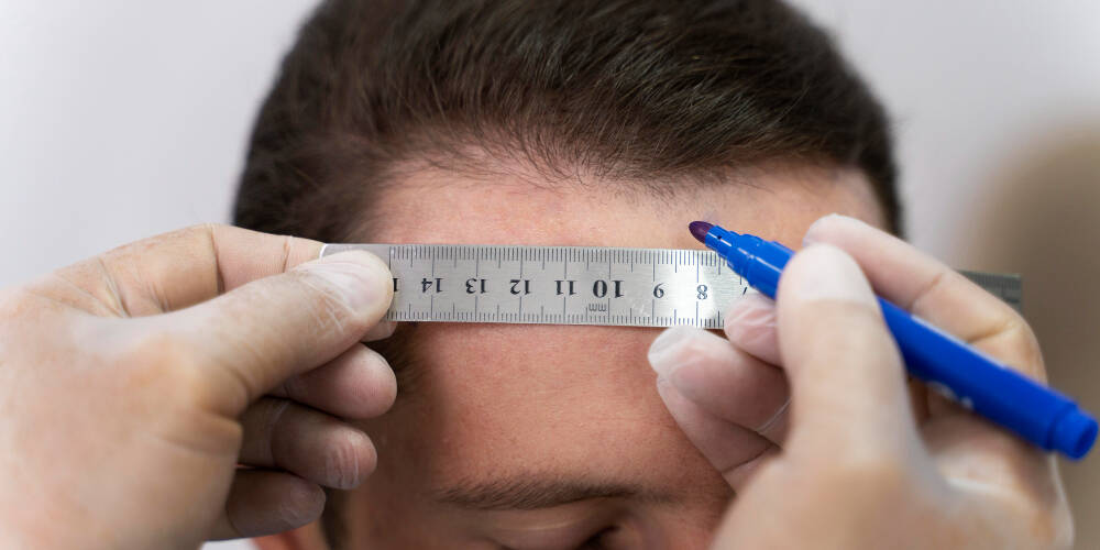 homem descobrindo se é possível fazer transplante capilar duas vezes