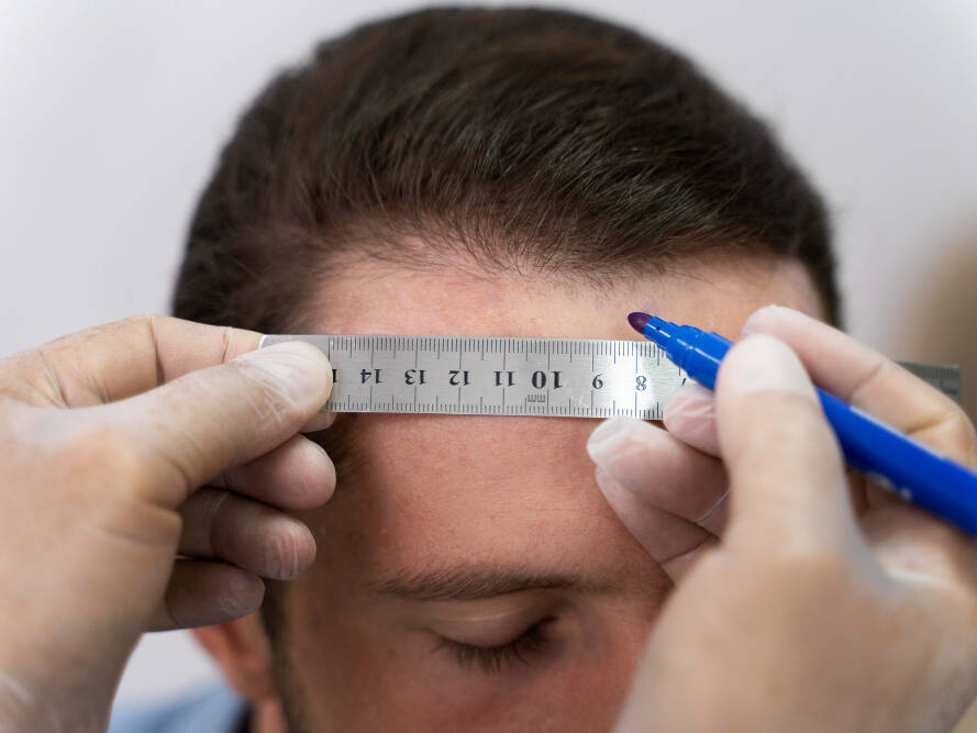 homem descobrindo se é possível fazer transplante capilar duas vezes