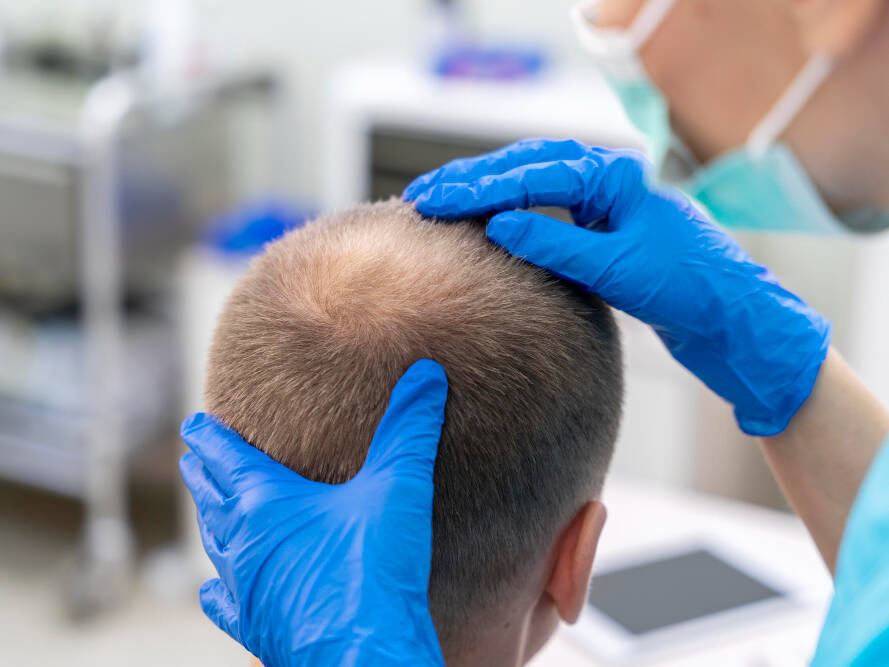 choque de queda após transplante capilar