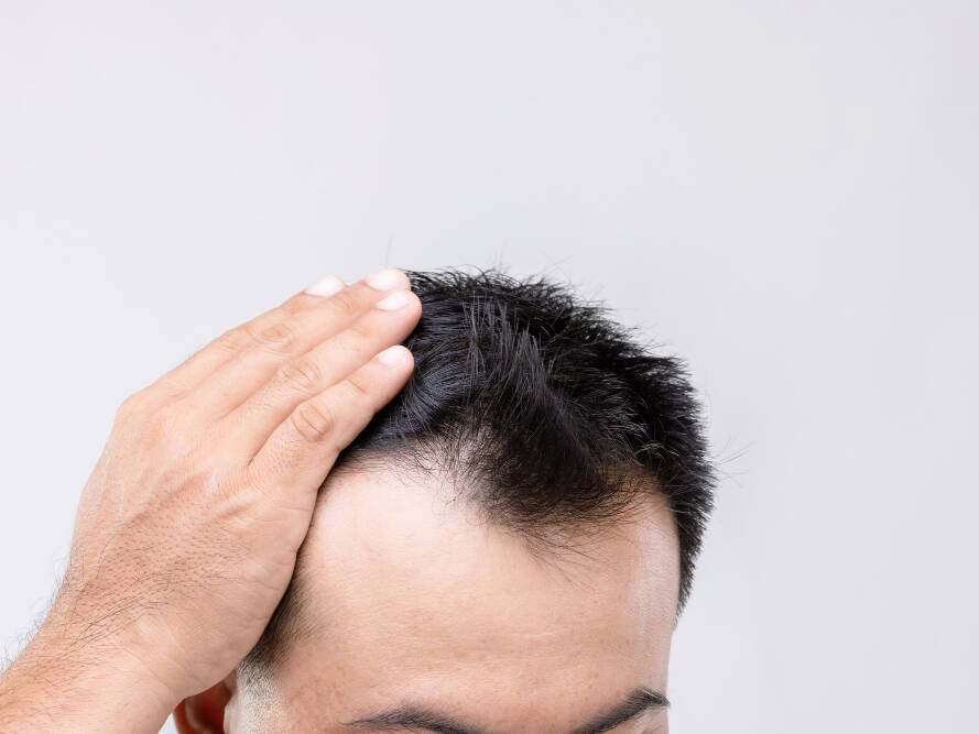 homem descobrindo com quantos anos pode fazer transplante capilar