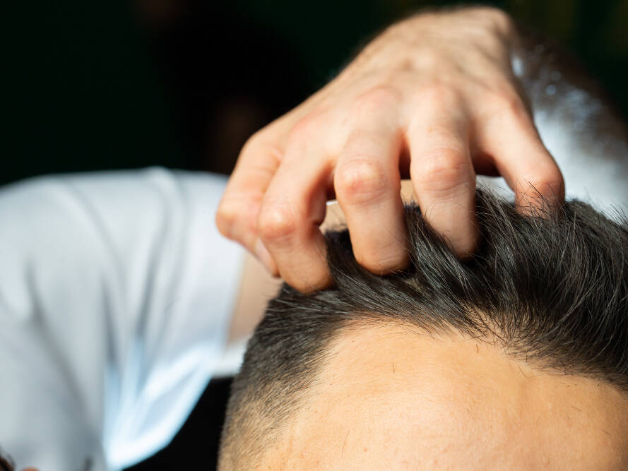 Aprendendo como avaliar fotos de antes e depois de transplante capilar