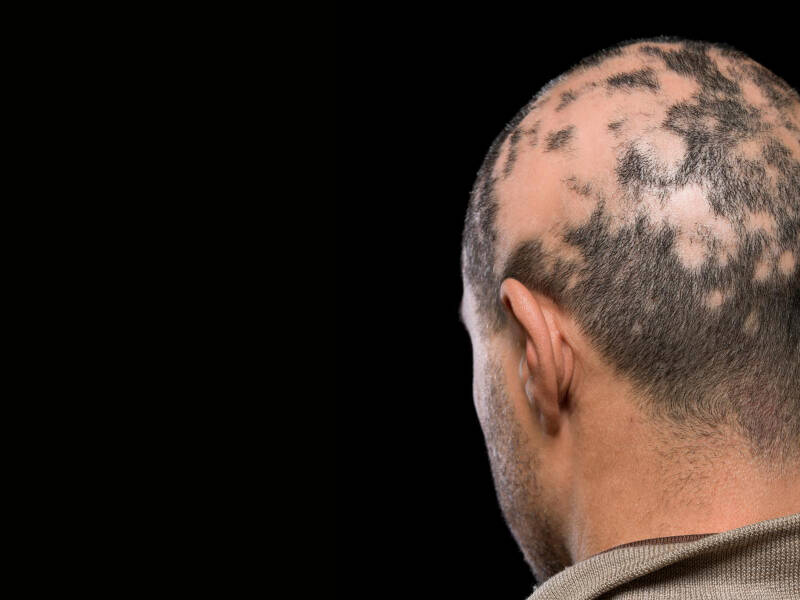 Alopecia na sobrancelha