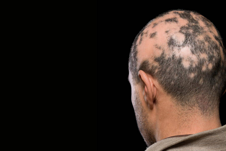 Alopecia na sobrancelha