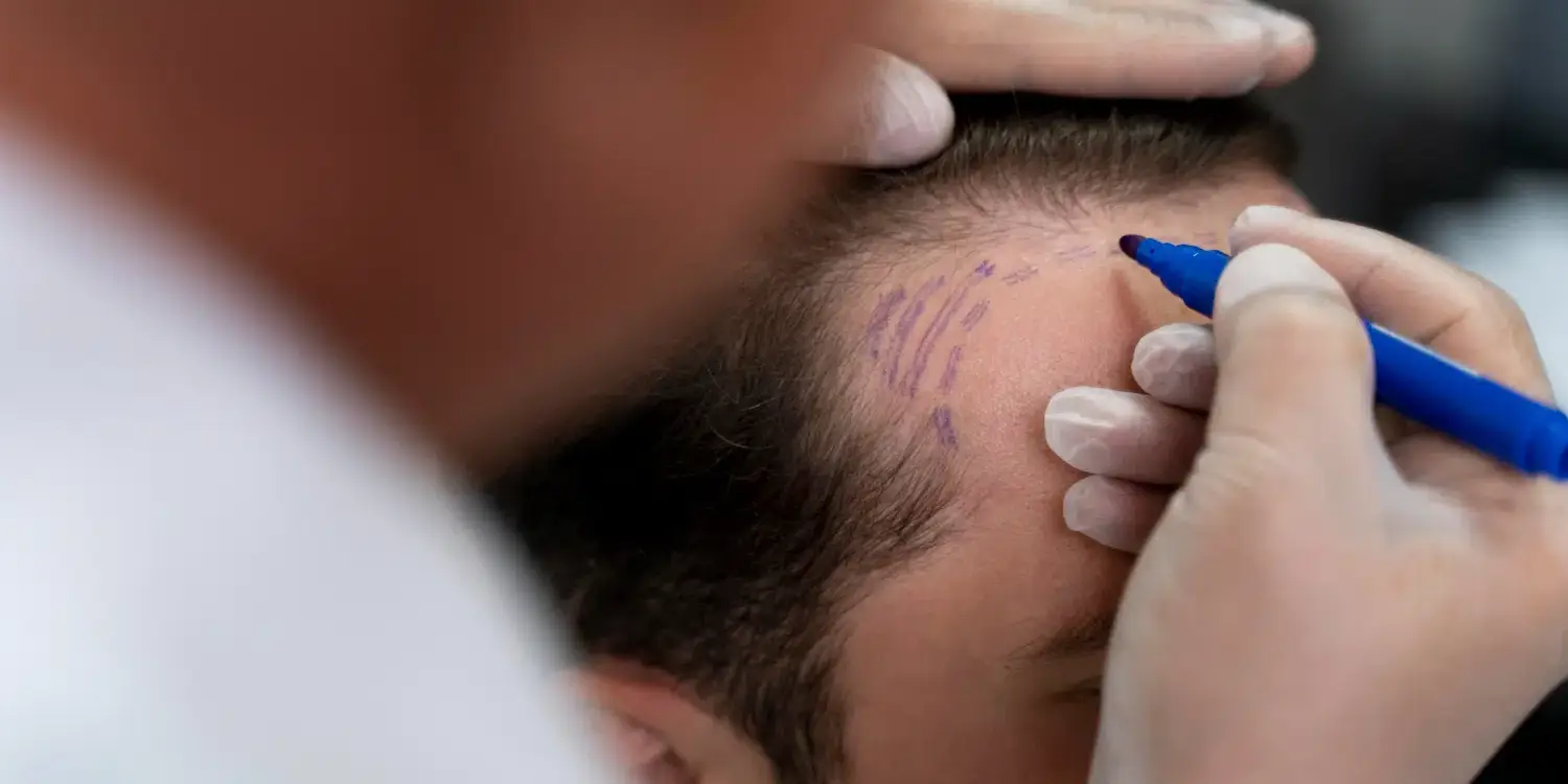 hairline natural