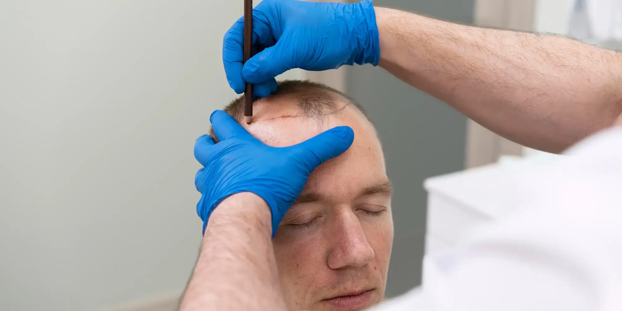 Médico realizando extração direta no paciente
