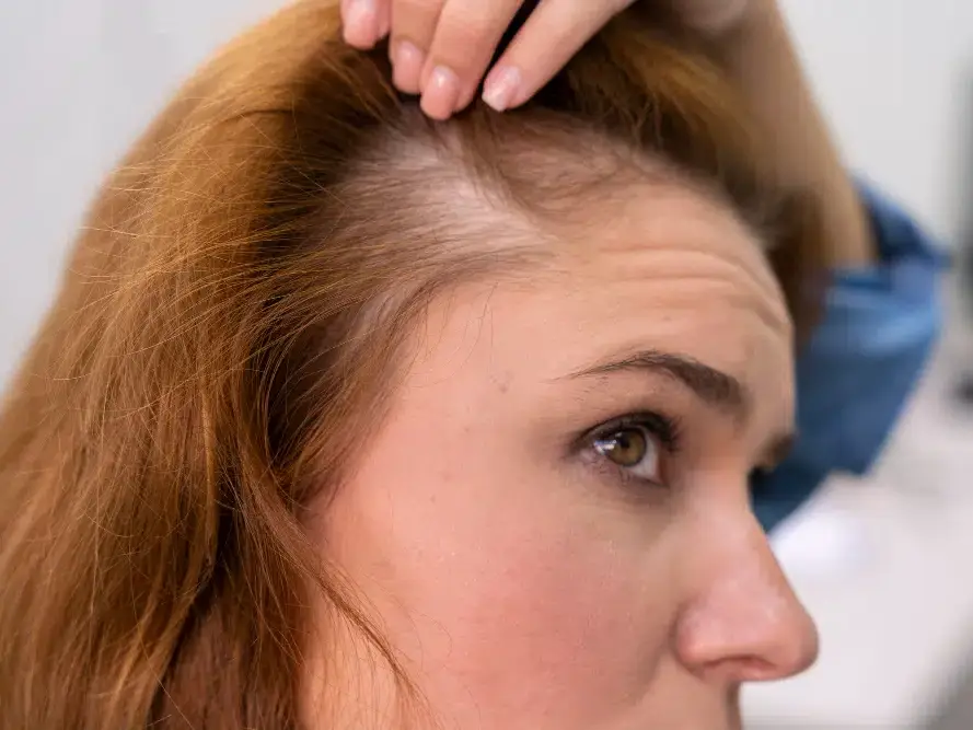Mulher de meia idade sofrendo com alopecia feminina