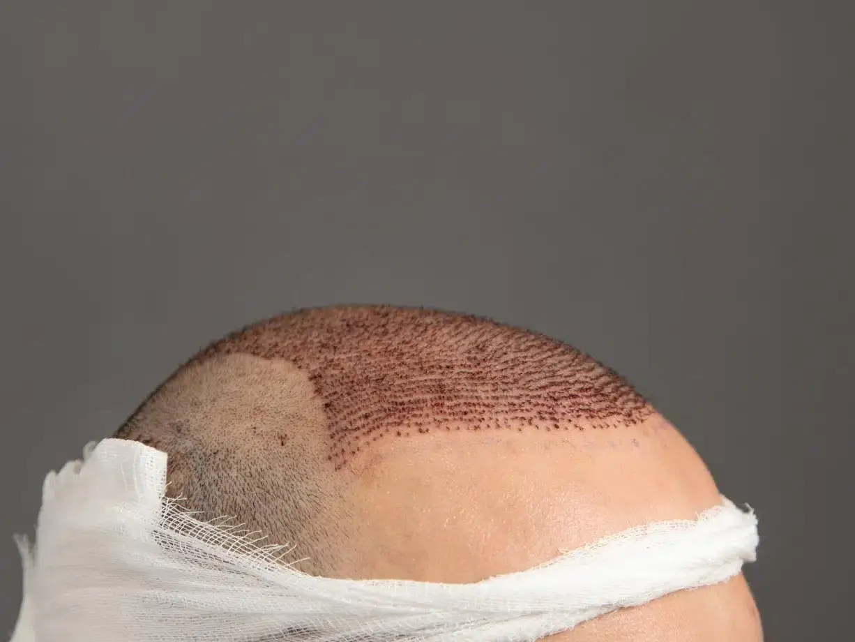 cabeça de homem depois de passar por megassessões de transplante capilar