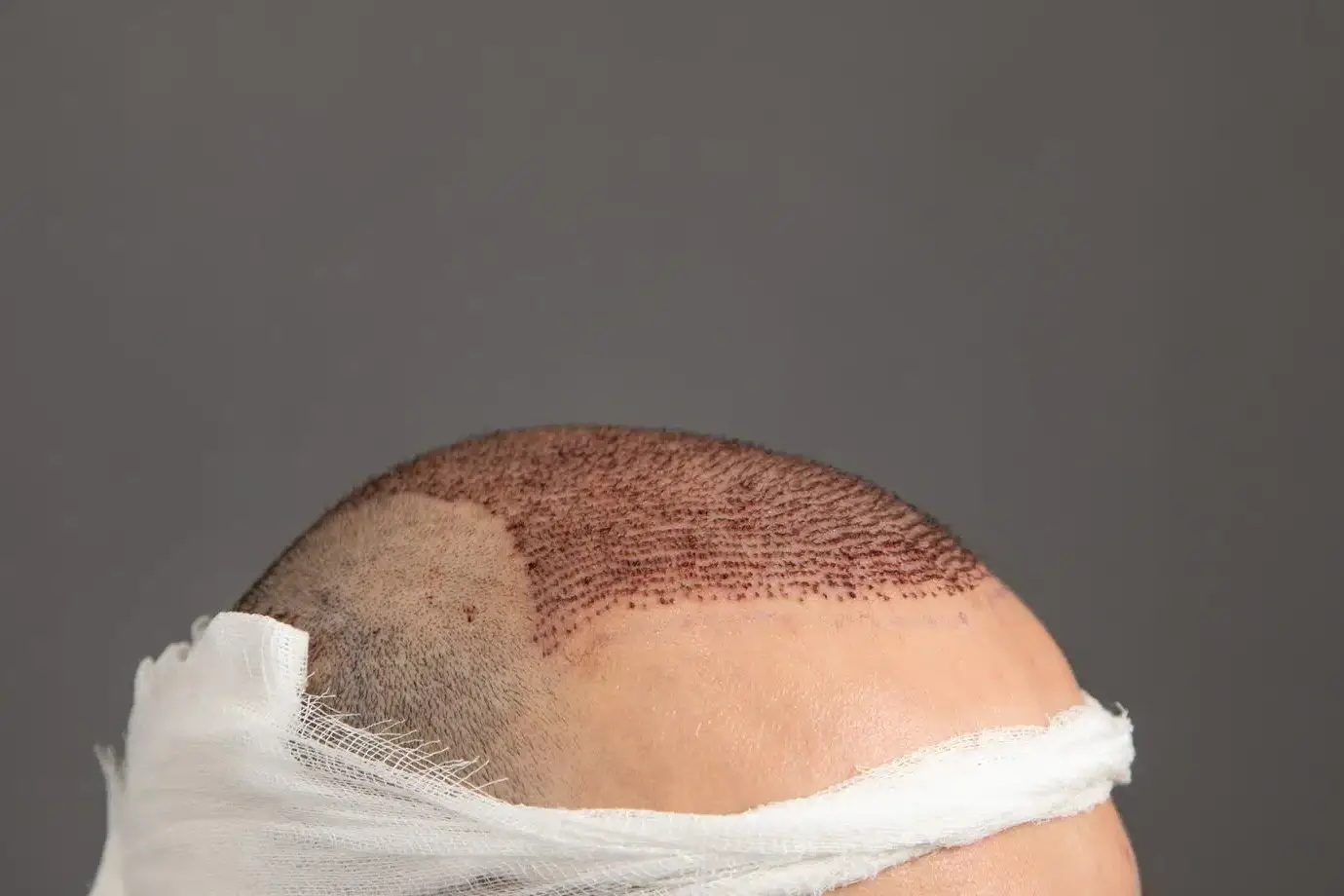 cabeça de homem depois de passar por megassessões de transplante capilar