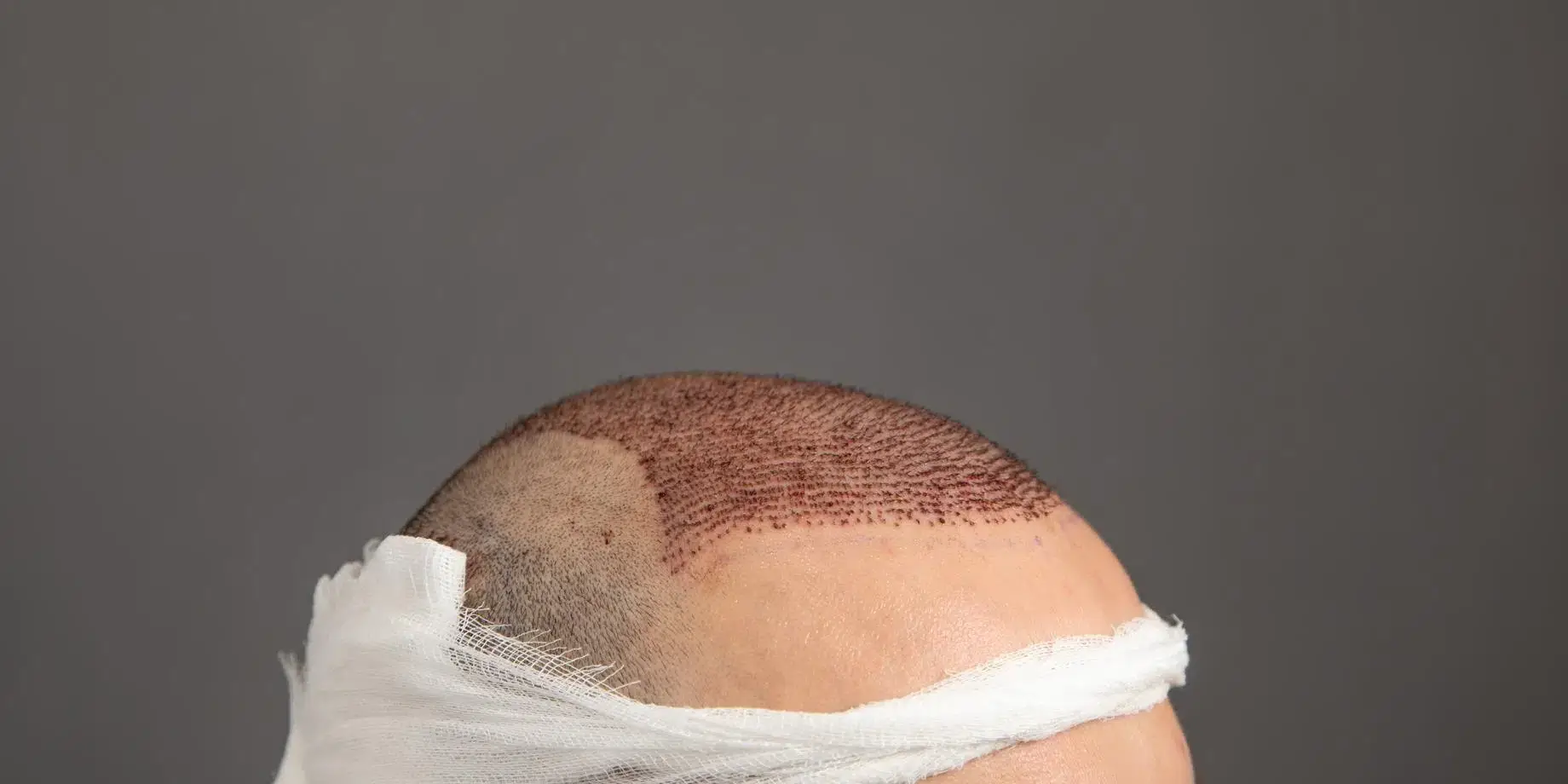 cabeça de homem depois de passar por megassessões de transplante capilar