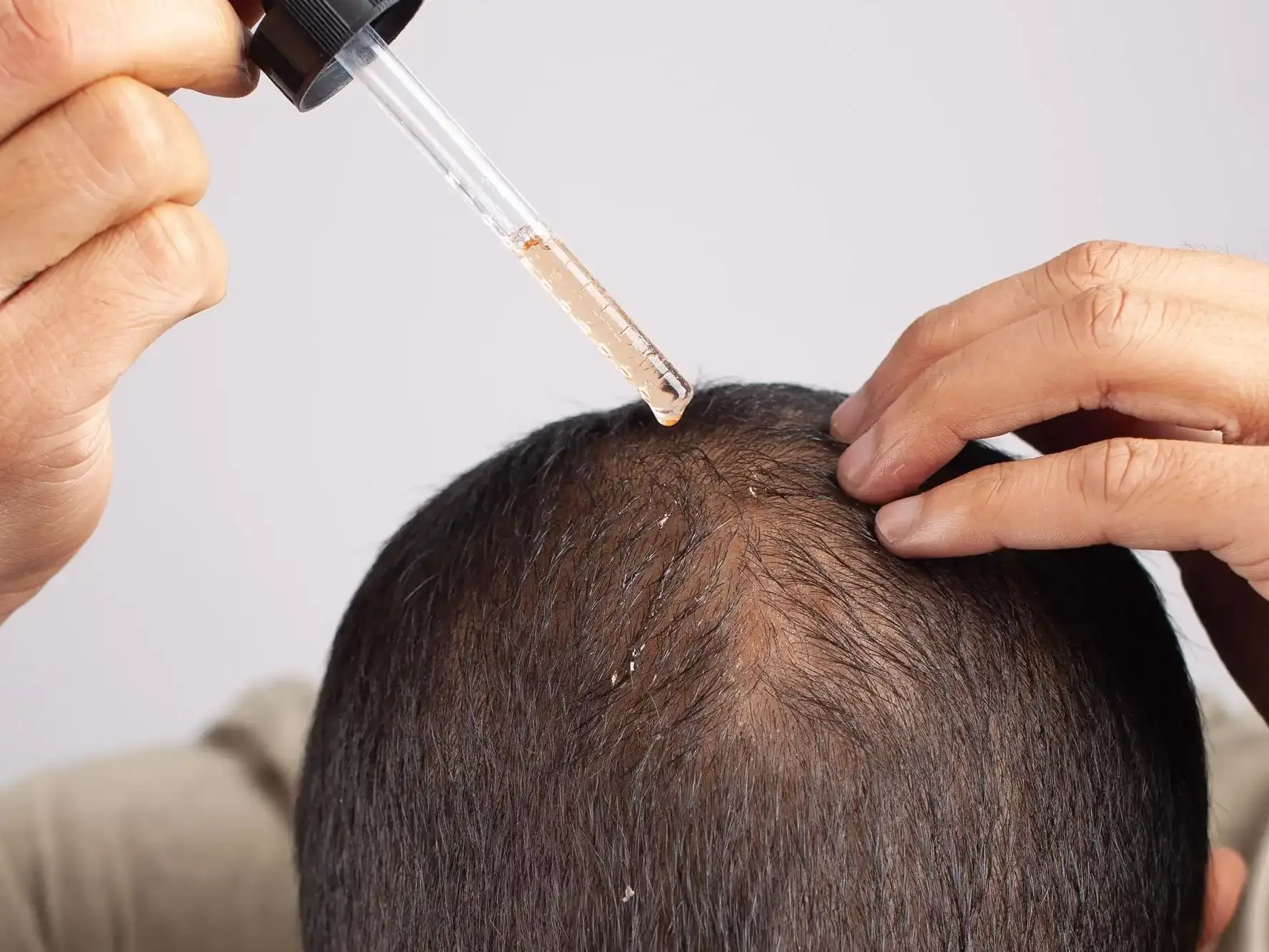 Finasterida para queda de cabelo