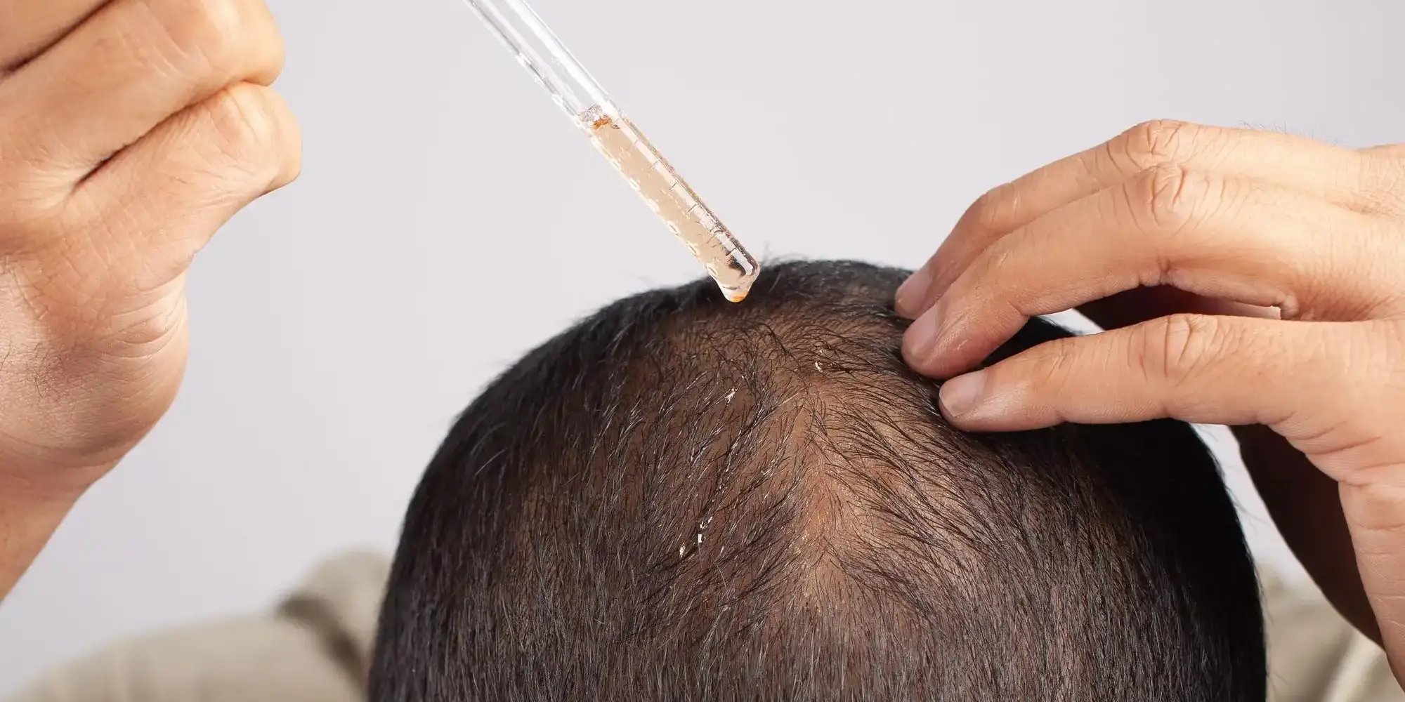 Finasterida para queda de cabelo