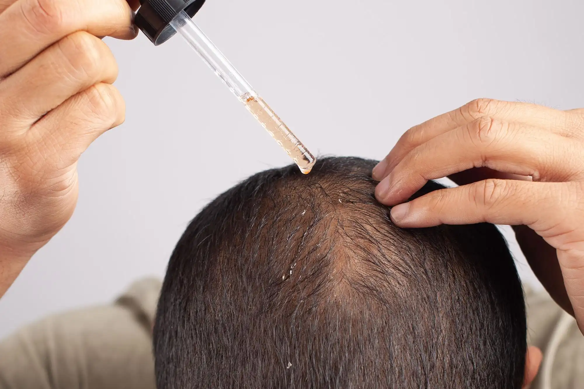Finasterida para queda de cabelo