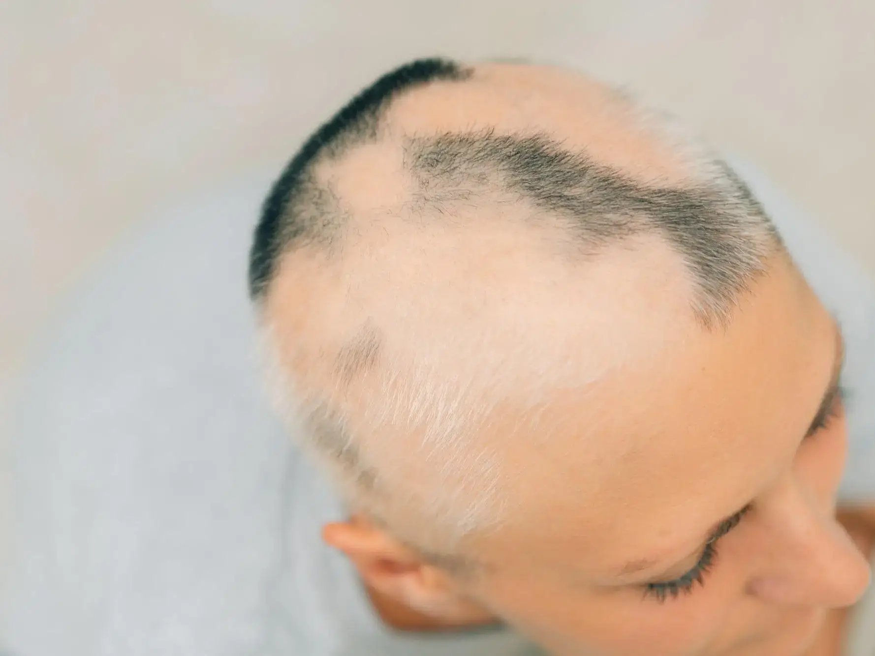 Alopecia cicatricial
