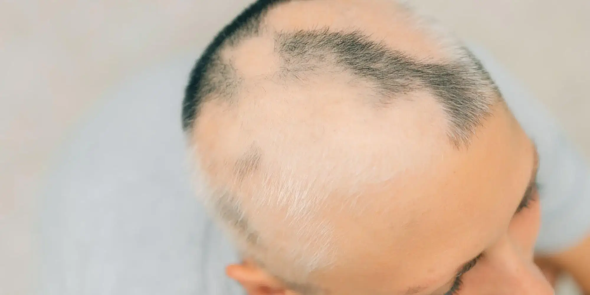 Alopecia cicatricial