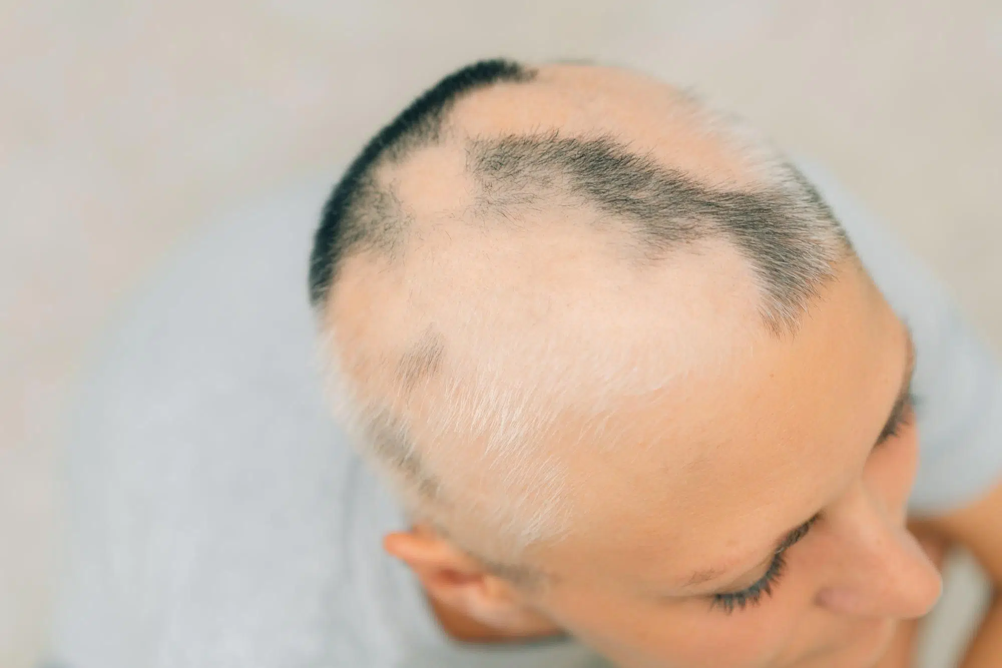 Alopecia cicatricial