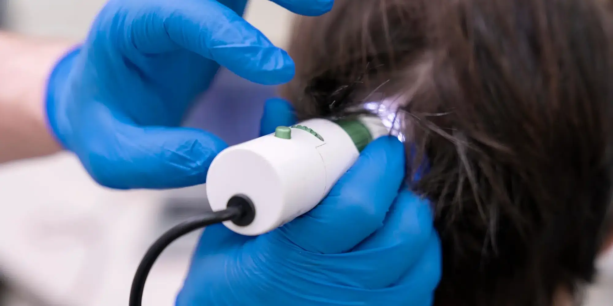 homem fazendo procedimento de laser capilar para queda de cabelo