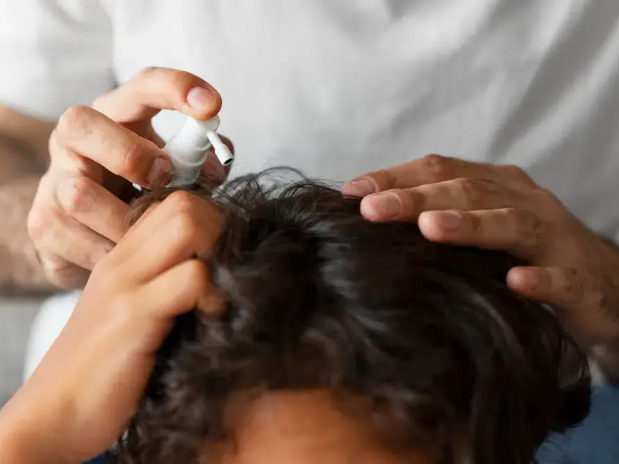homem usando minoxidil oral para queda de cabelo