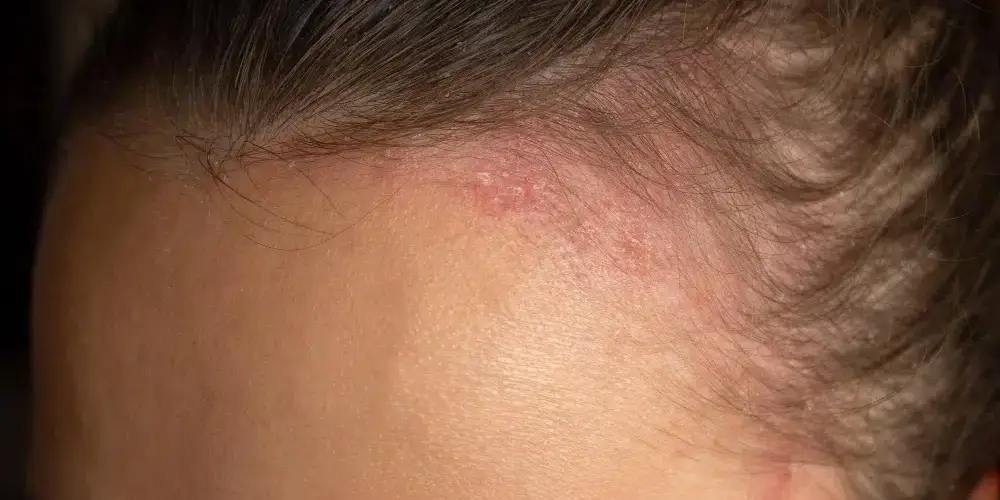 mulher com dermatite seborréica e queda de cabelo