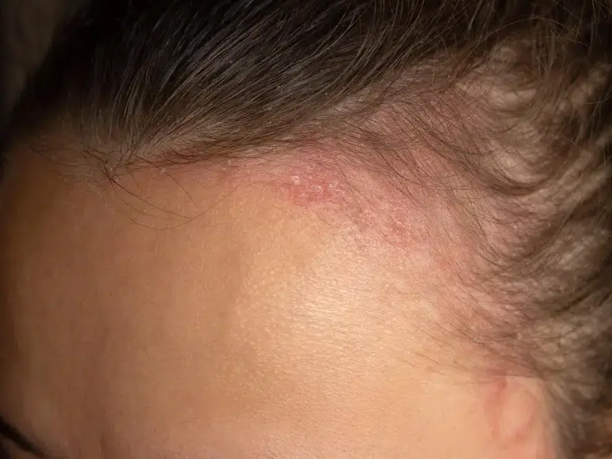 mulher com dermatite seborréica e queda de cabelo
