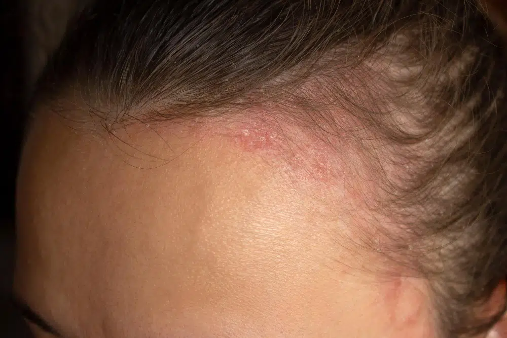 mulher com dermatite seborréica e queda de cabelo
